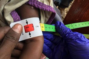 Ein Arzt misst im Sudan den Armumfang eines schwer unterernährten Babys (Archivbild) - Foto: Eva-Maria Krafczyk/dpa