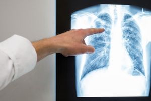 Röntgenbild einer Lunge. Im vergangenem Jahr würden rund 4480 neue Tuberkulose-Fälle in Deutschland registriert. - Foto: Silas Stein/dpa