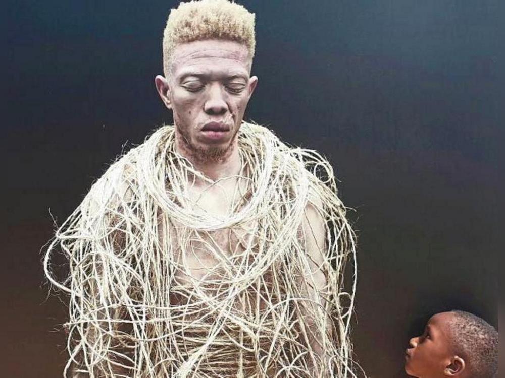 Gefangen im eigenen Körper: In Afrika haben es Albinos nicht leicht. Zuweilen werden sie verfolgt, entführt und auch getötet.