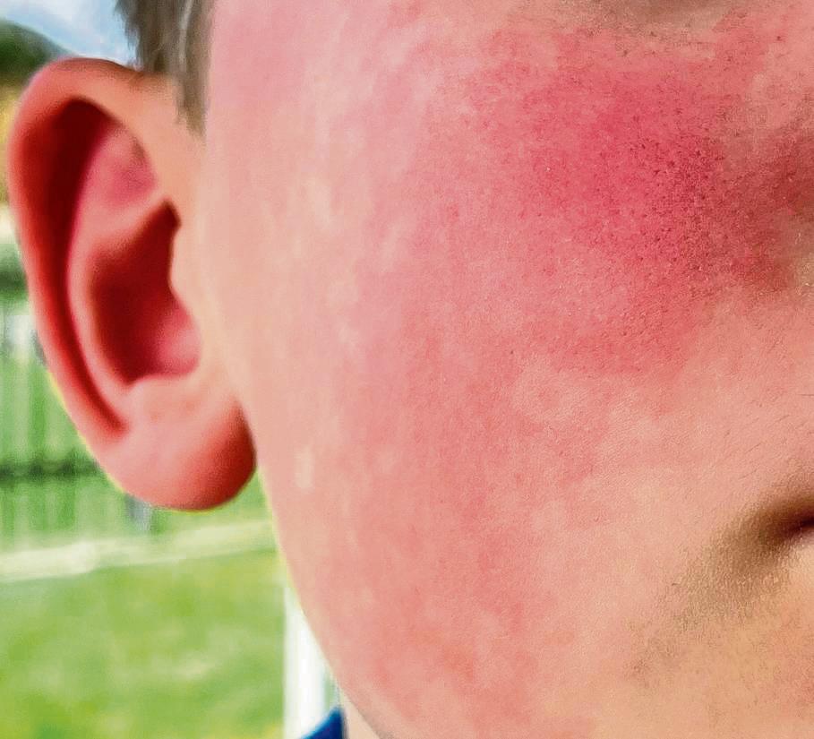 Roter Ausschlag an den Wangen ist ein Symptom bei Ringelröteln. Sobald er sich zeigt, geht die Ansteckungsgefahr deutlich zurück. Foto: Winkelmann