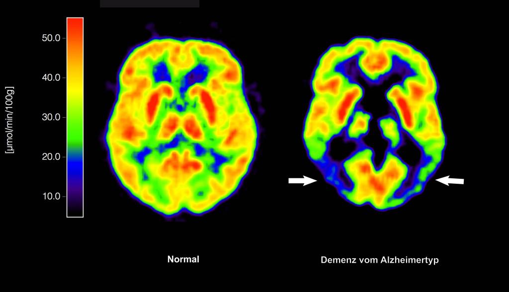Lecanemab richtet sich gegen Amyloid-Ablagerungen im Gehirn und soll dadurch den Verlauf der Krankheit ein wenig verlangsamen. (Archivbild) - Foto: Lutz Kracht/MPI/dpa
