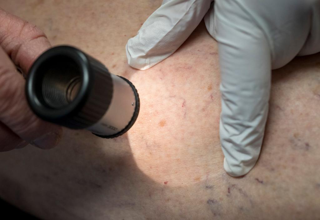 Die Zahl der Krankenhausbehandlungen von Hautkrebs stieg enorm an. (Symbolbild) - Foto: Peter Kneffel/dpa