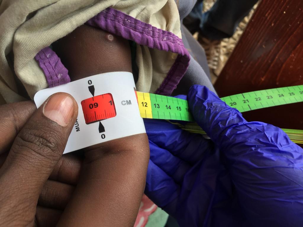 Der Armumfang eines schwer unterernährten Babys in Somalia wird gemessen. (Archivbild) - Foto: Eva-Maria Krafczyk/dpa