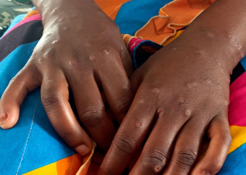 Mpox ist vor allem für kleine Kinder und immungeschwächte Menschen gefährlich (Archivbild) - Foto: Janvier Barhahiga/AP/dpa
