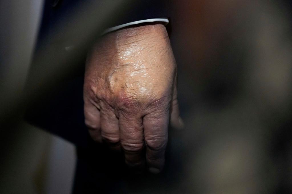 Nachdem der Bluterguss am Handrücken für Aufsehen sorgte, wurde er häufig bei Auftritten zugeschminkt. (Archivbild) - Foto: Julia Demaree Nikhinson/AP/dpa