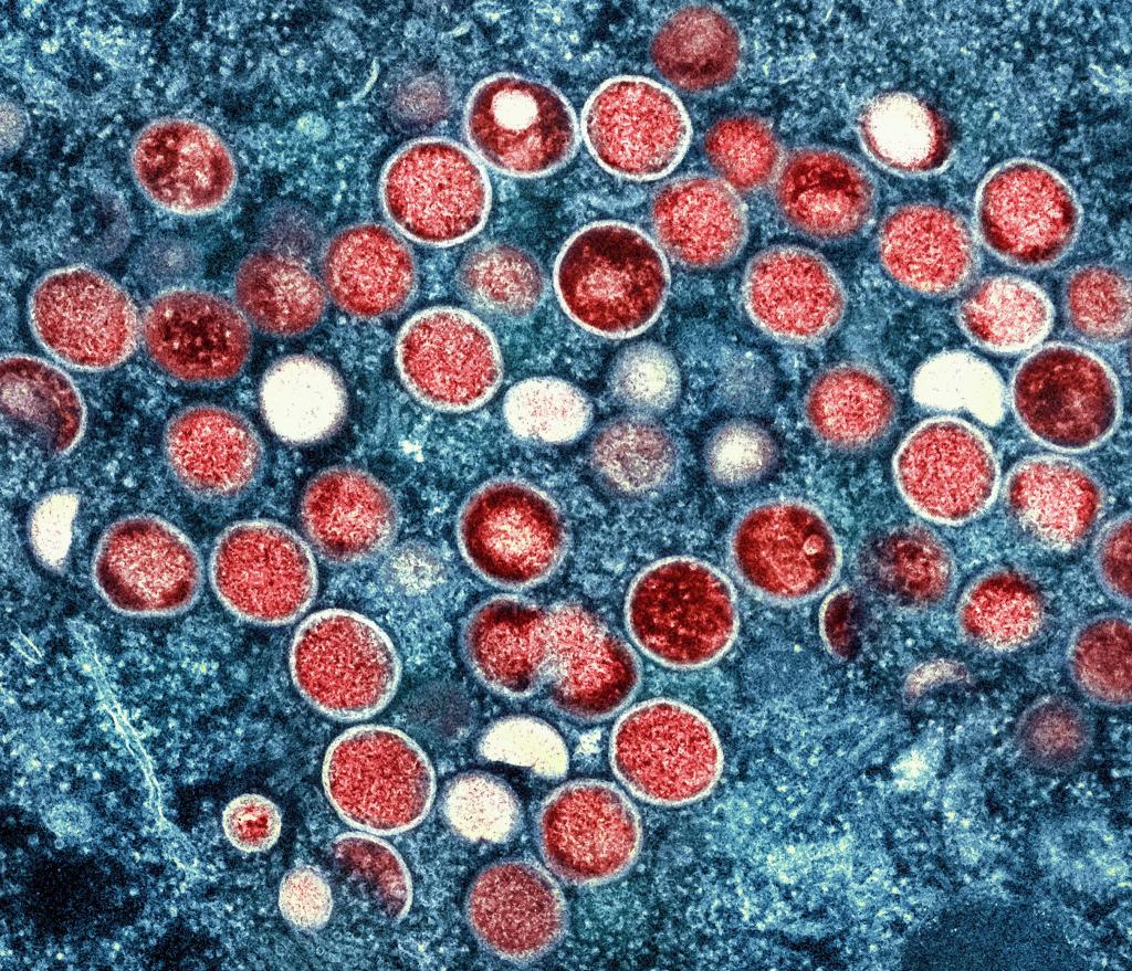  Beim Menschen wurden Mpox erstmals 1970 in der Demokratischen Republik Kongo identifiziert (Symbolbild). - Foto: -/National Institute of Allergy and Infectious Diseases/dpa